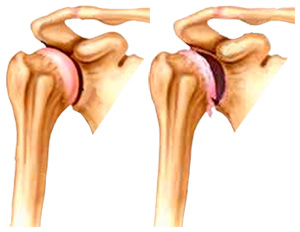 edema with joint pain