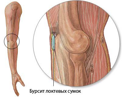 ligos alkūnės sąnario bursitas artritas ir artrozė jų gydymo