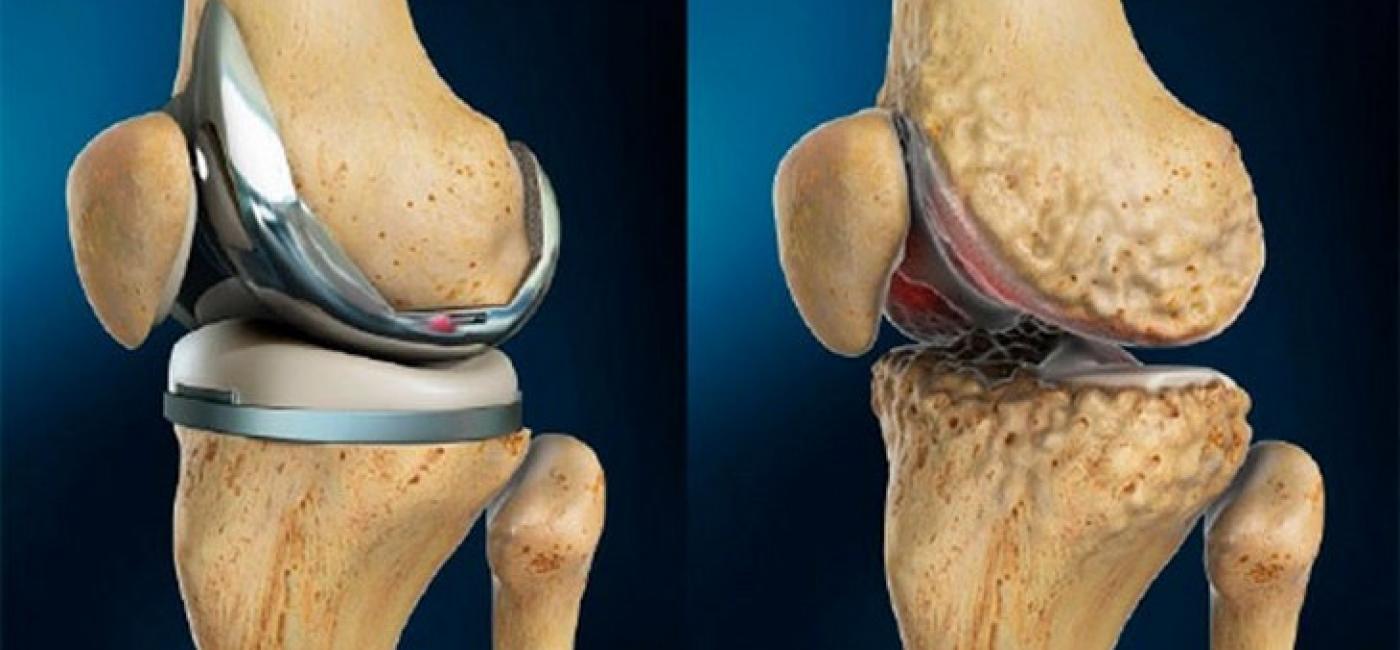 gydymas osteoartrito bts nei tepinėlis nuo skausmo sąnarių