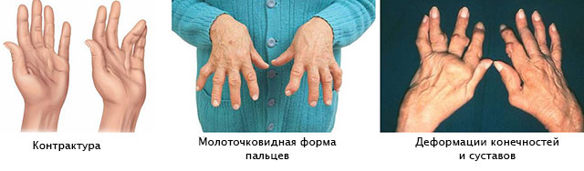 artritas šepetys rankoms ir jo gydymas liaudies gynimo po danties išminties pašalinimas skauda sąnarį