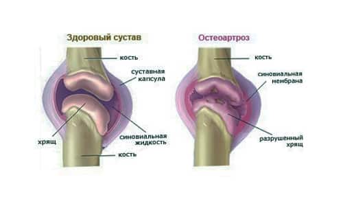 liaudies gynimo kaulų ir sąnarių kas yra gydomi artrozės žandikaulio