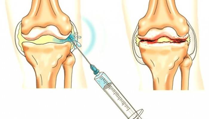 nuomonės apie osteoartrito gydymą išminčius nuo sąnarių skausmo