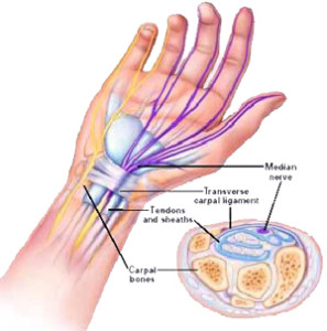 gerklės riešo sąnarių ant rankos priežastis sustaines raiška ligos