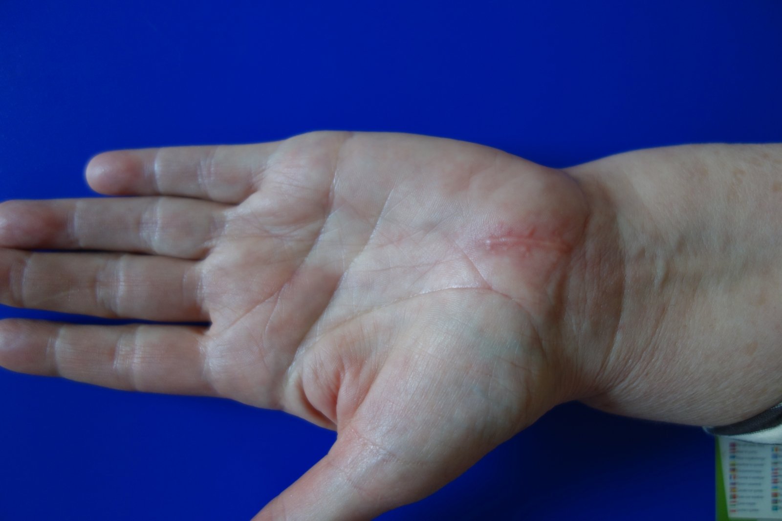 artritas dideliame piršto kairės rankos tendobursts peties bendrą gydymo