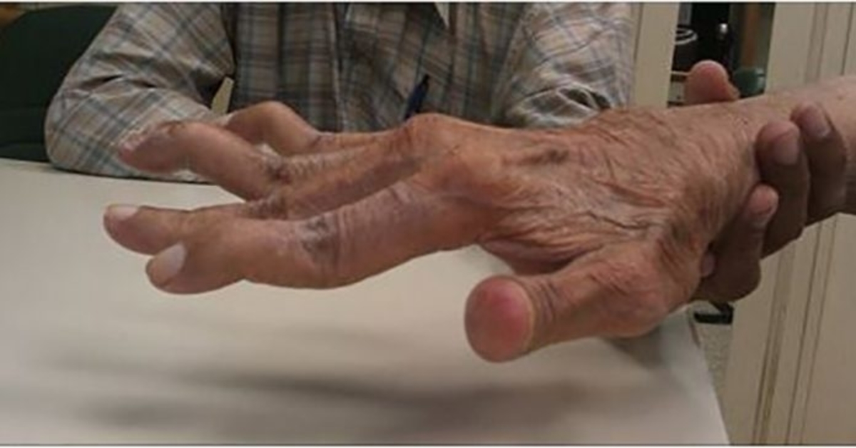 artritas mažų sąnarių gydymo filmas iš sąnarių skausmas