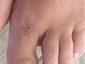 artritas mazgai ant piršto varžtai vien sąnarių pečių
