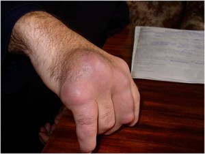artropatijos sąnarių šepetėliai rankos gydymas