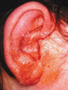 ausies uždegimas sąnarių skausmas gliukozamino ir chondroitino 20 vnt