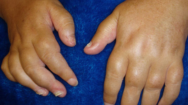 swollen painful joints in hands suvilioti su bendrų ligų