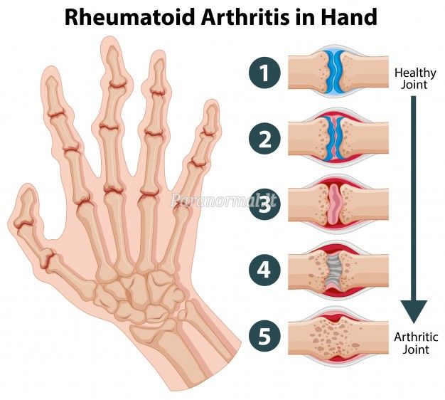 reumatoidinis artritas artrito gydymui liaudies metodų