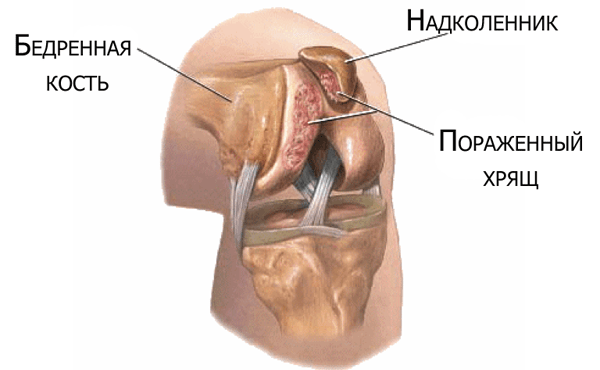 artrologija sąnarių skausmas