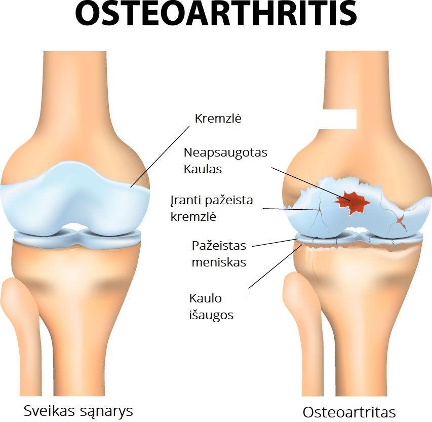 osteoartritas tyrimai su peties sąnario skausmai