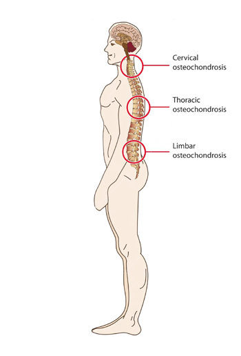 usteochondrozė osteochondrozė guzas ant alkūninio artrito