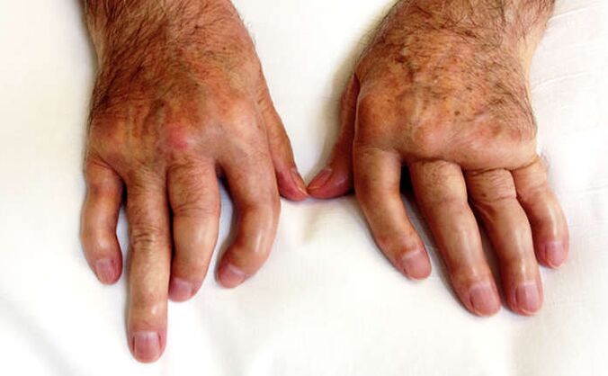 graikų artritas rankų visos priemonės iš sąnarių