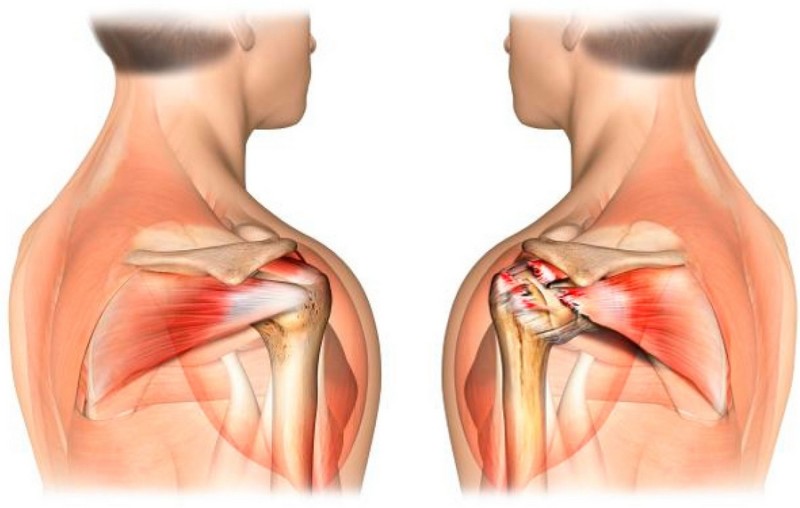 prakaitavimas skausmą kai svorio paryškintas raumenų sąnarių pečiai