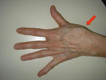 bursito artritas nykščio artrozė iš sąnarių loopy