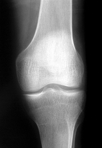 gogress artrozė pėdų gydymas artrozė sąnarių gydymas liaudies metodų