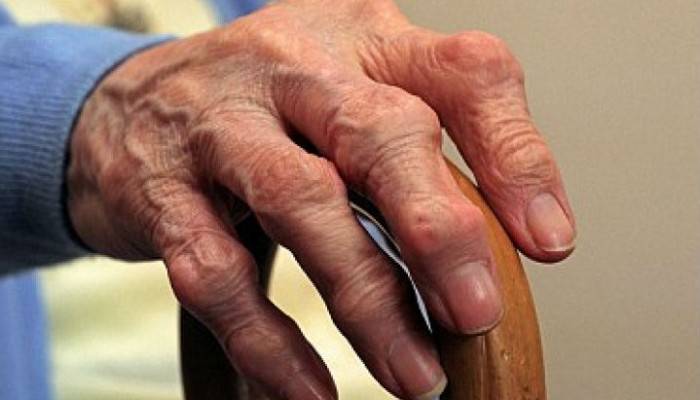 gydymas osteoartrito rankų šepetys liaudies gynimo kaip pašalinti skausmą ir uždegimą pirštų sąnarių