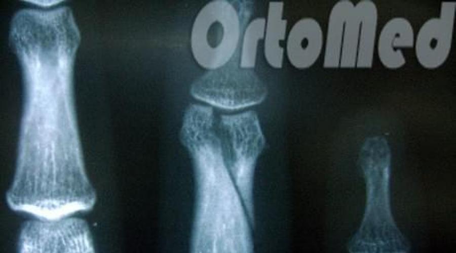 gydymas osteoartrito rankų šepetys liaudies gynimo šokinėja skausmą po arkliukas