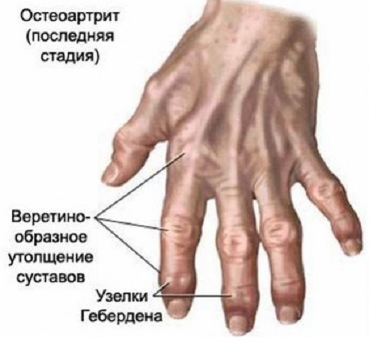 gydymas osteoartrito rankų šepetys liaudies gynimo medicina iš sąnarių artrozė ligų