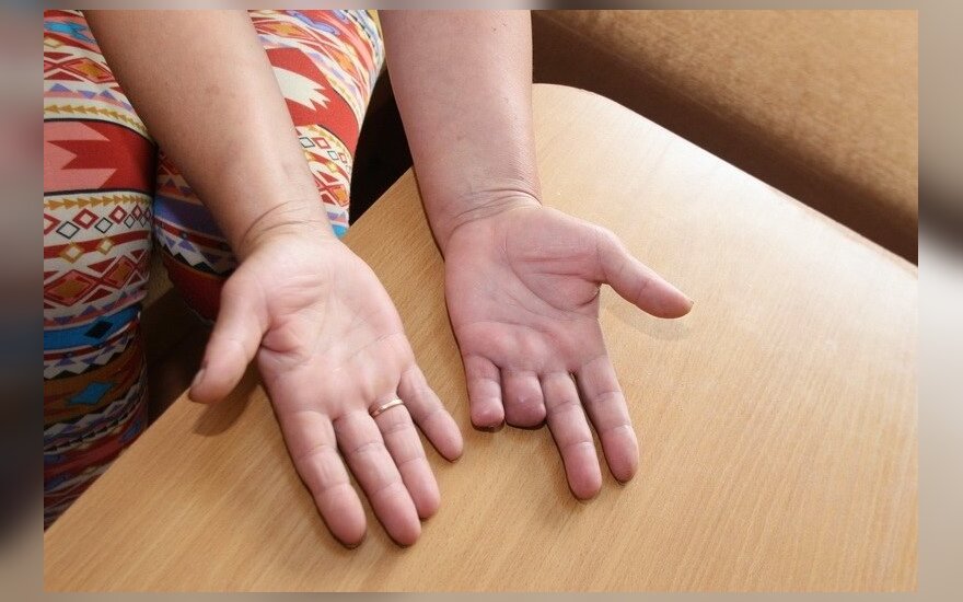 gydymas rankos delnų sąnarių