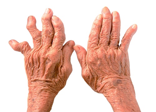 infekcinio artrito šepečių rankos