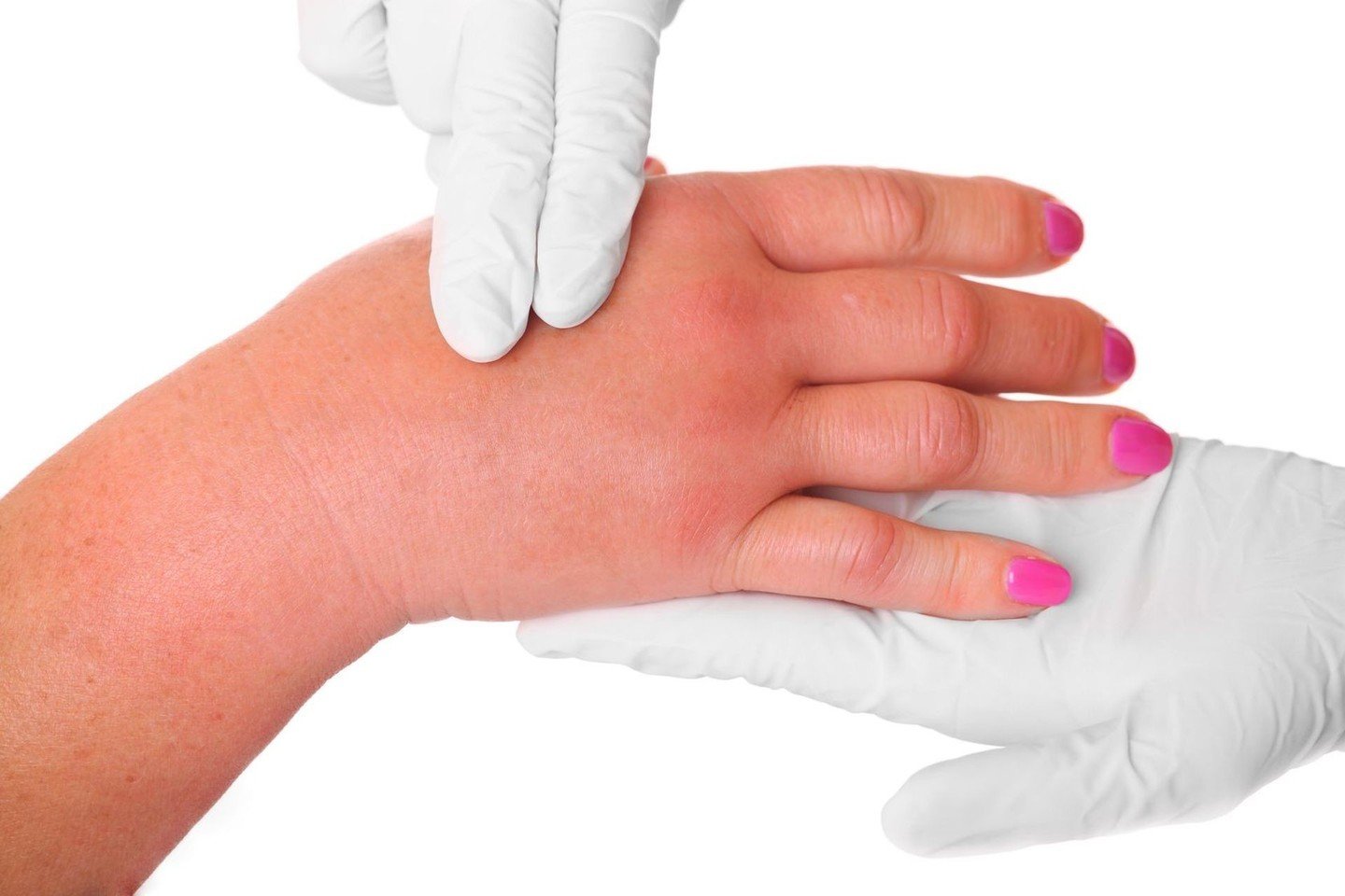 kaip atsikratyti skausmas rankų ir pirštų sąnarių kokios ligos yra sąnariai