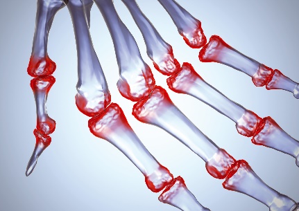 liaudies gydymas artritas ir artrozė gerklės nykščio gydymas