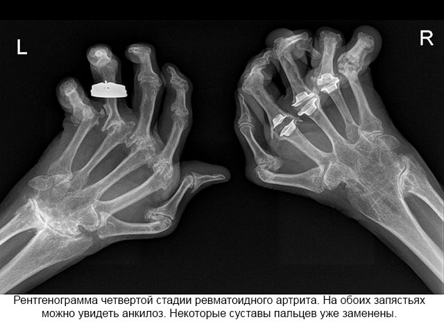 liaudies medicina artritas praėjusio sustav gerklės riešo sąnario rankos