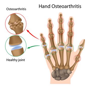 nuomonės apie osteoartrito gydymą skausmas alkūnės sąnarių kas tai yra
