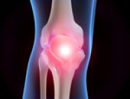 gydymo artritas artrozė apžvalgų tepalas prieš sąnarių skausmas