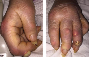odos liga dėl rankų sąnarių artritas artrozė gydymo apžvalgų