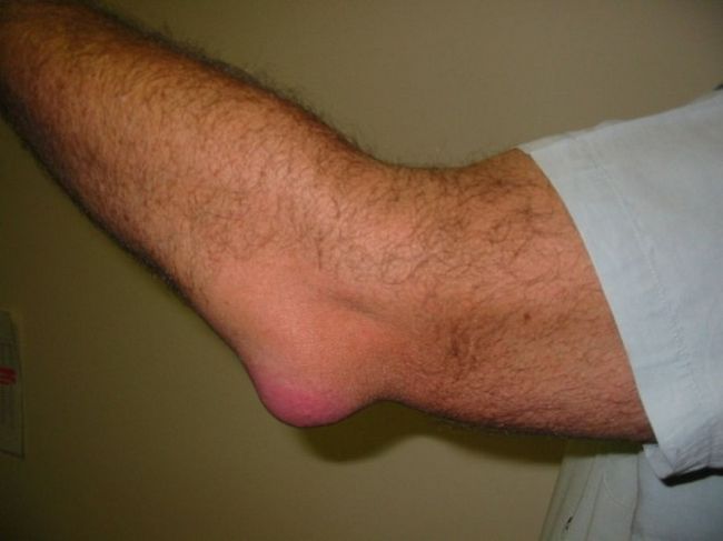 rankų skauda alkūnės sąnario ir dilbio reumatoidinis artritas skauda ranką