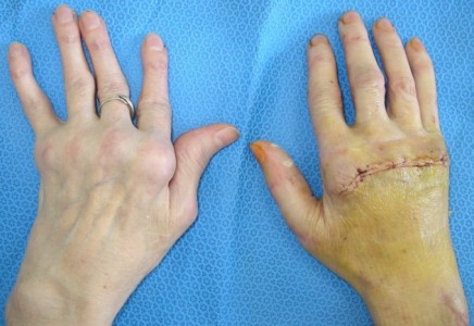 rankų traumos ant piršto liga pasireiskianti sanariu skausmais