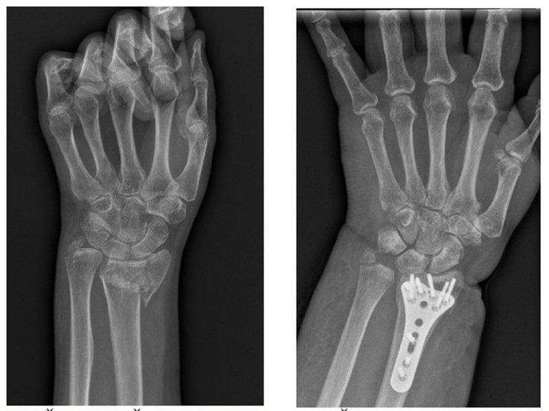 rankos sąnario ant riešo ranka gydymo gydymas artritu rankas liaudies gynimo sąnarių