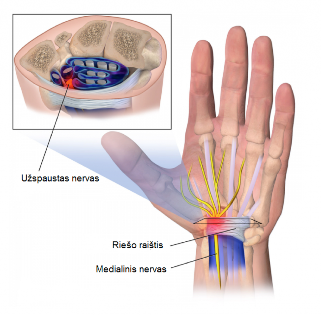 reumatoidinis artritas nykščio gydymas