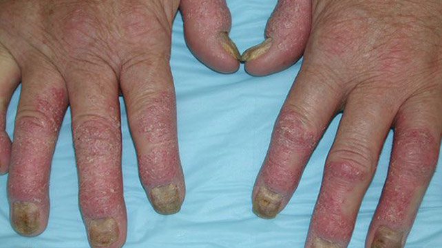 swelling in joints and rash