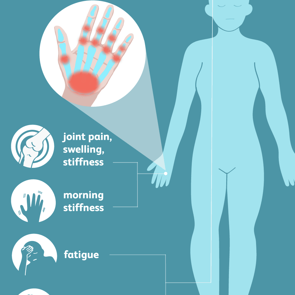 reumatoidinis artritas artrito gydymui liaudies metodų