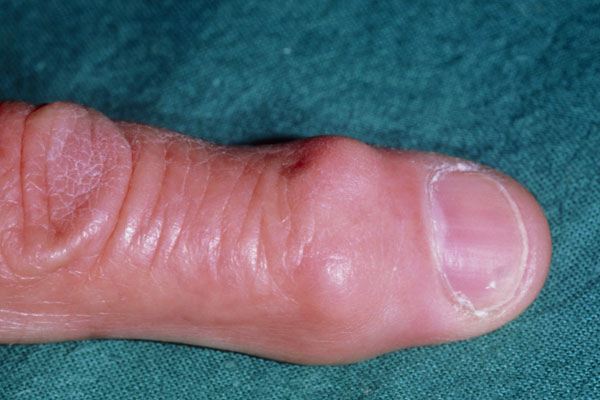 swelling in knuckle joints patinimas ant alkūnės sąnario be skausmo