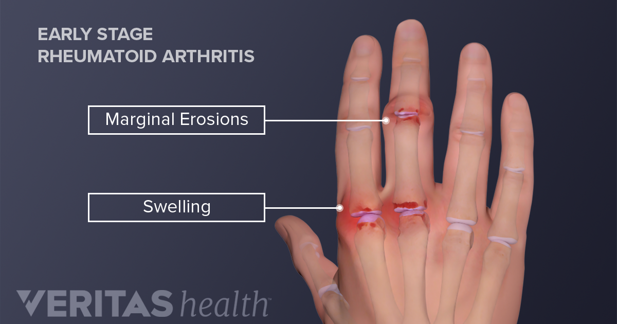 swelling in knuckle joints kas gali būti susijusi su rankų sąnarių