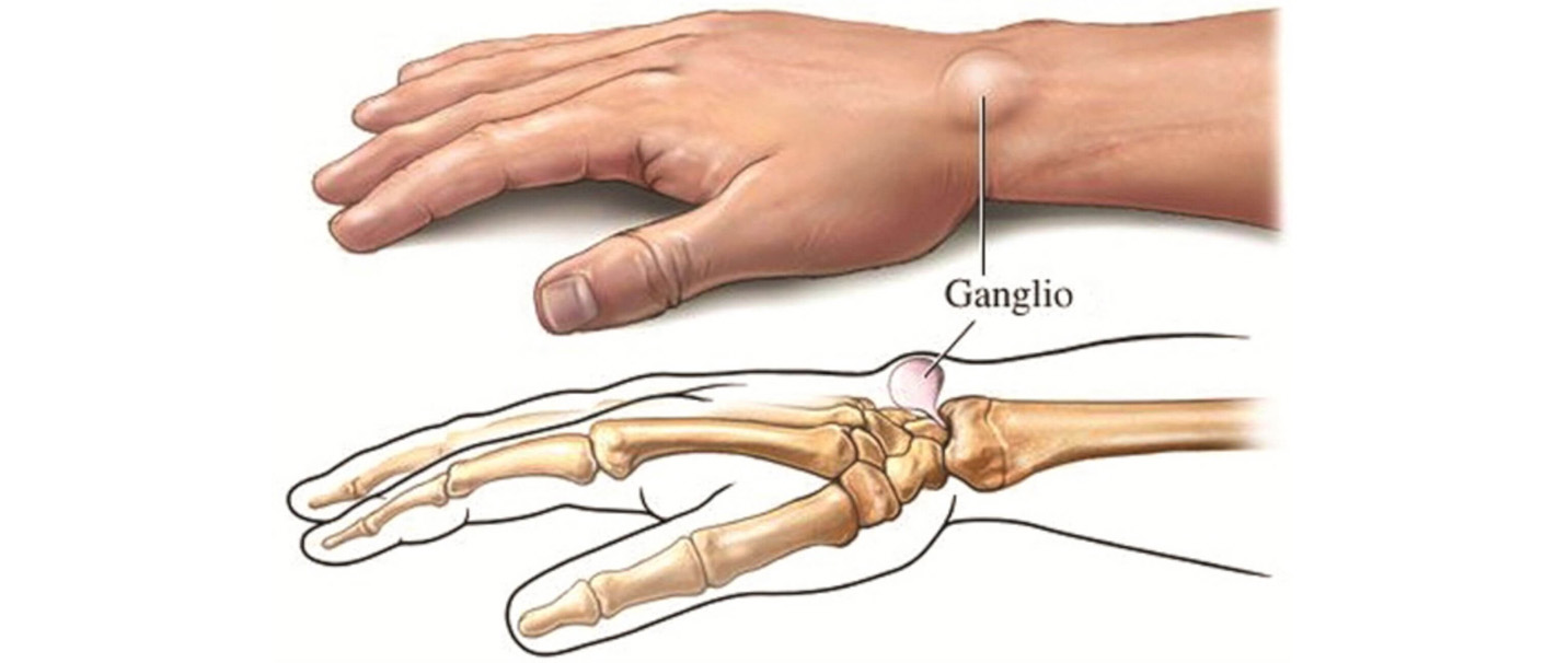 patinimas riešo sąnario rankų gydymui bauda sąnarių gydymas