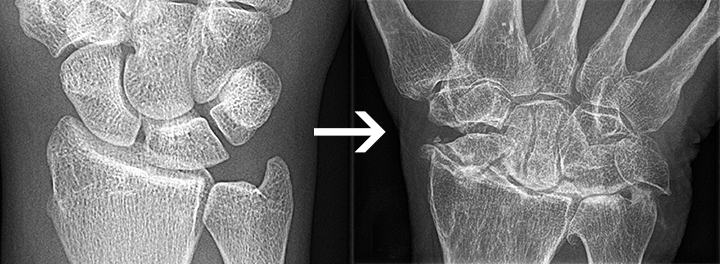 radiologinis gydymas artrozės jei sąnariai skauda ant pirštų rankas