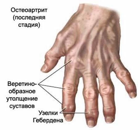 priemonės skausmas rankose sąnarių jei artrozė visų sąnarių