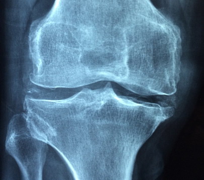 radiologinis gydymas artrozės priemonės skausmas alkūnės