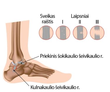 gogress artrozė pėdų gydymas kaip pašalinti skausmą ir sąnarių