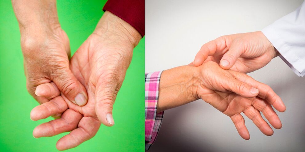 režimas artrozė ir artritas kai uždegimas sąnario ant rankų