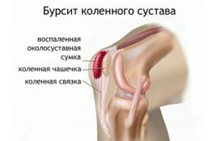 artritas bendrų peržiūrų ligos nuo pėdos sąnarių
