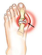 artrozė apatinių sąnarių pėdos