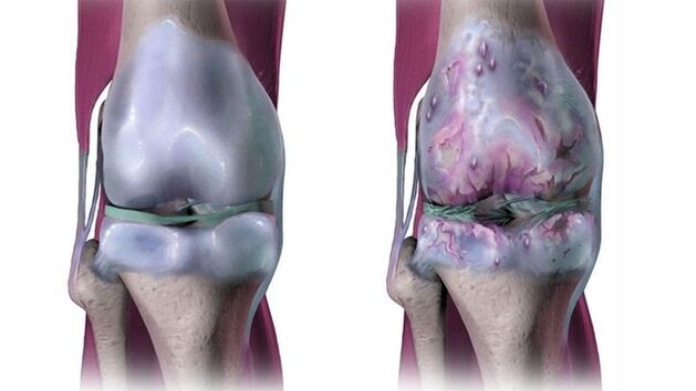osteoartrito grandinės artritas sustav pėdų sukelia gydymas