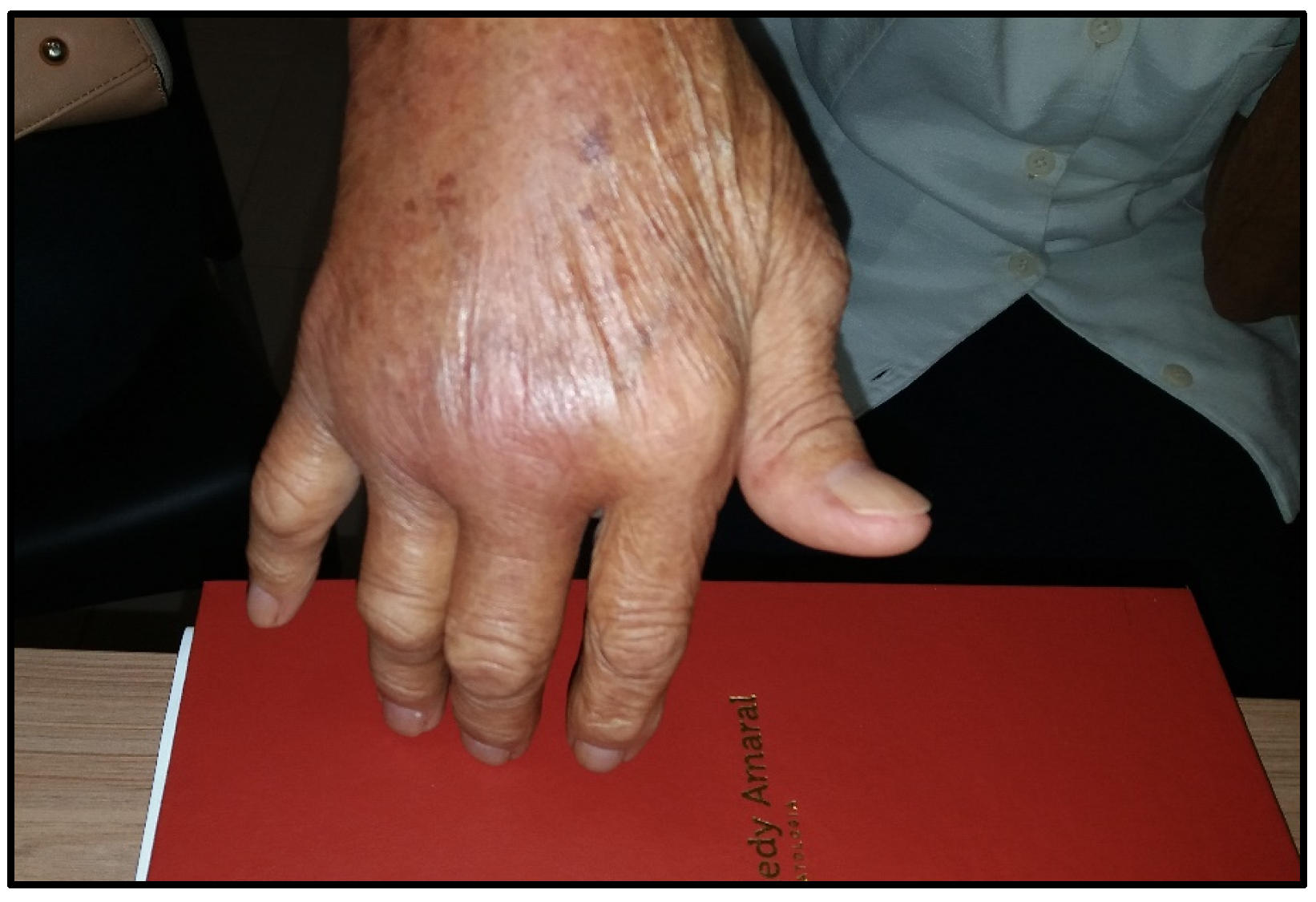 artritas sust liaudies artritas falanga pirštas